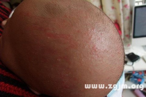 梦见头长疮的评论_百田解梦